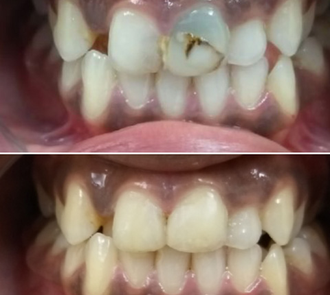 Before / After Treatment